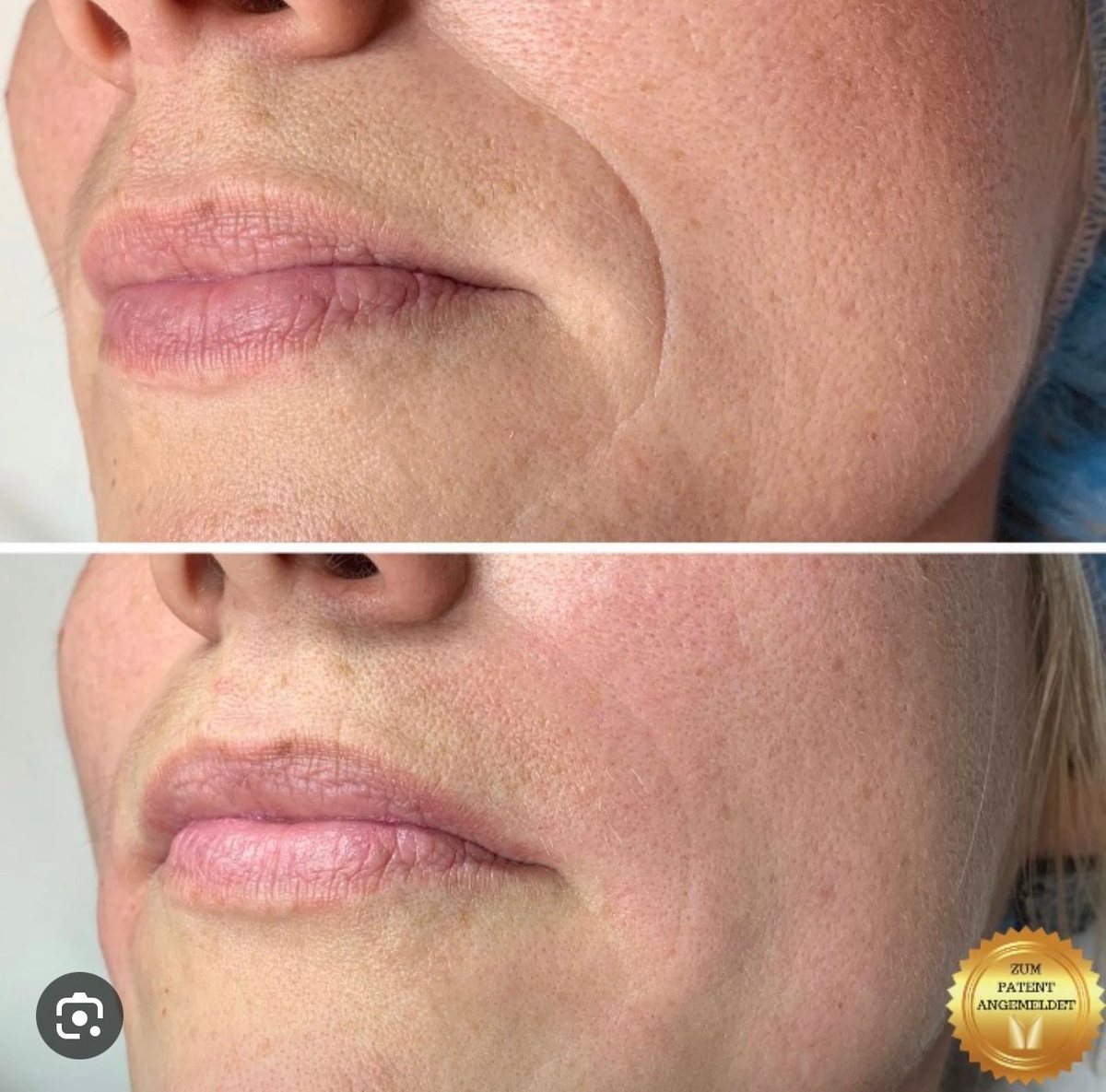 Lippen vor und nach der Behandlung — Mundwinkel und Nasolabialregion
