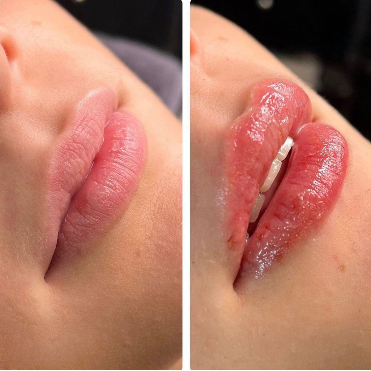 Lippen vor und nach der Behandlung — Volumenaufbau