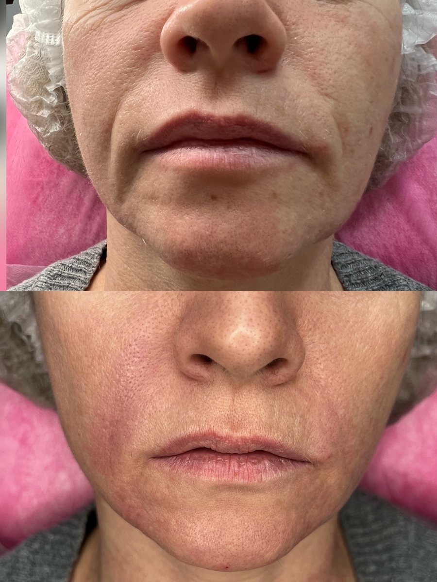 Mundpartie vor und nach der Behandlung — Falten um die Lippen