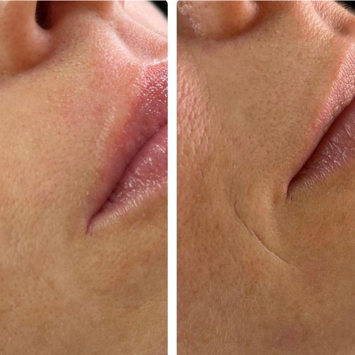 Lippen und Nasolabialregion vor und nach der Behandlung