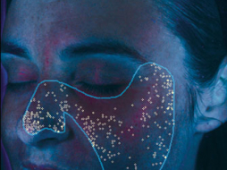 VISIA-Analyse: Porphyrine