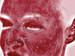 VISIA-Analyse: Rote Bereiche