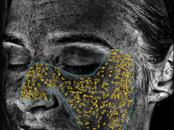 VISIA-Analyse: UV-Flecken