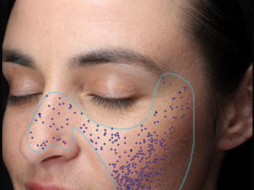 Poren sind kreisrunde Öffnungen der Schweißdrüsenkanäle an der Hautoberfläche.